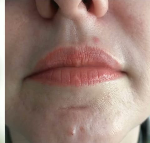 Antes do preenchimento labial