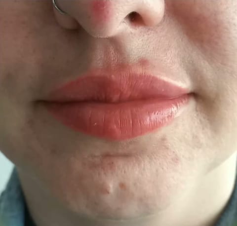 Depois do preenchimento labial, com contorno e volume naturais
