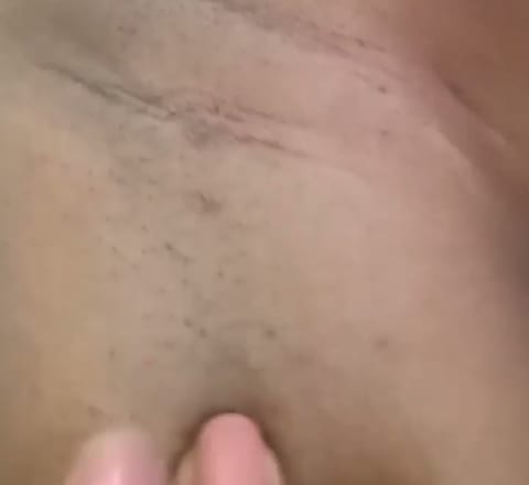Tratamento de foliculite com a Dra. Cris Oliveira